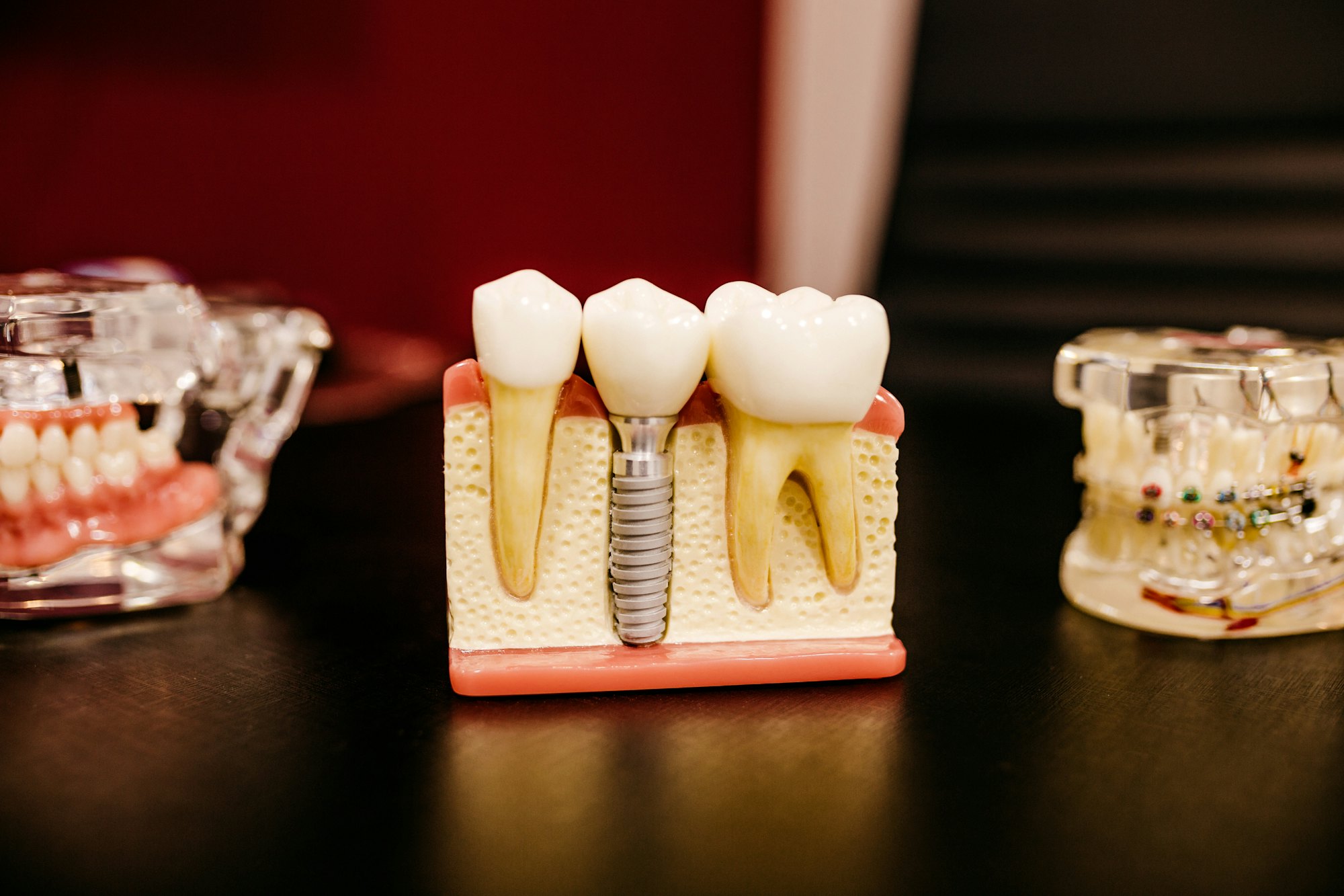 Implant and crown demonstration models